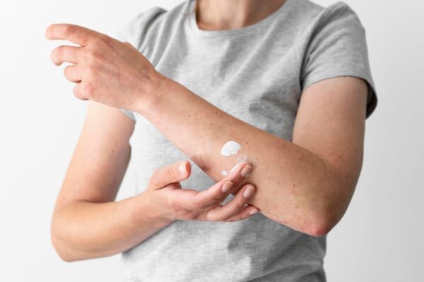 Dermatita atopică