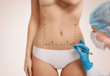 Abdominoplastie: remodelarea chirurgicala a abdomenului